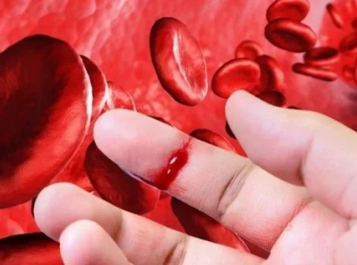 Αιμορροφιλία τι είναι; Tι προκαλεί; Πώς αντιμετωπίζεται; Πρώτες βοήθειες αιμορραγικού επεισοδίου